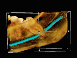 Impacted wisdom teeth